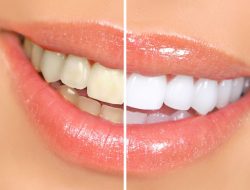 5 Cara Ampuh Memutihkan Gigi Dengan Bahan Alami yang Mudah Kita Temukan