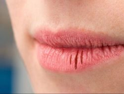 5 Penyebab Bibir Kering dan Pecah-pecah, Berikut Ini Cara Mengatasinya