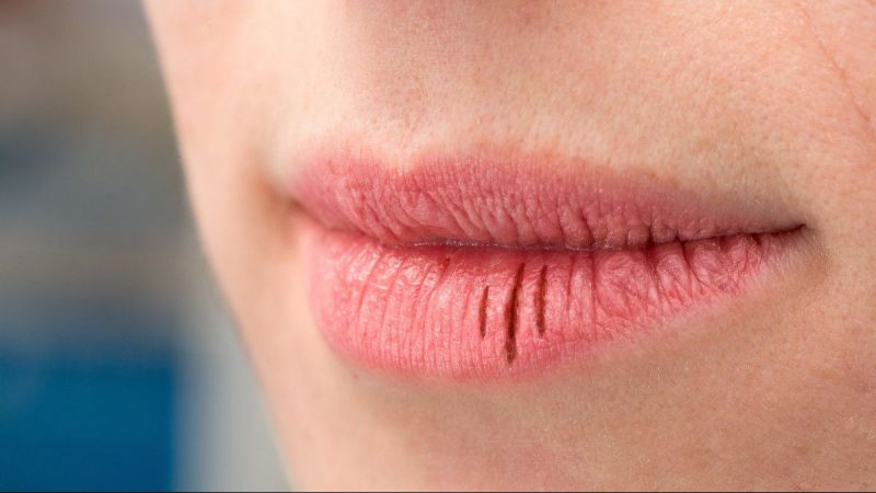 5 Penyebab Bibir Kering dan Pecah-pecah, Berikut Ini Cara Mengatasinya