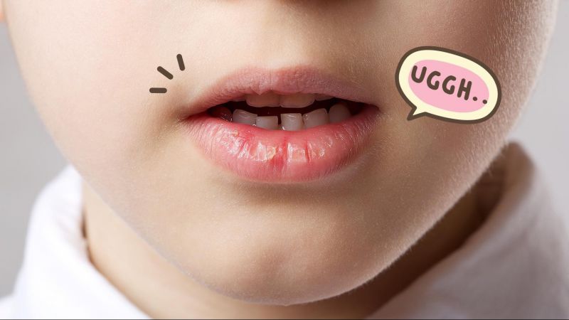 Menyembuhkan Bibir Pecah-pecah dan Kering Dengan 9 Cara Ini