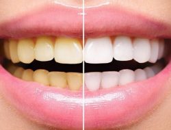 Ini 7 Bahan Alami yang Ampuh Memutihkan Gigi Kuning