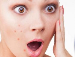 Ini 6 Penyebab Jerawat Terus Bermunculan di Wajah