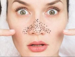 Ini 5 Penyebab Munculnya Komedo di Area Hidung, Salah Satunya Karena Masker