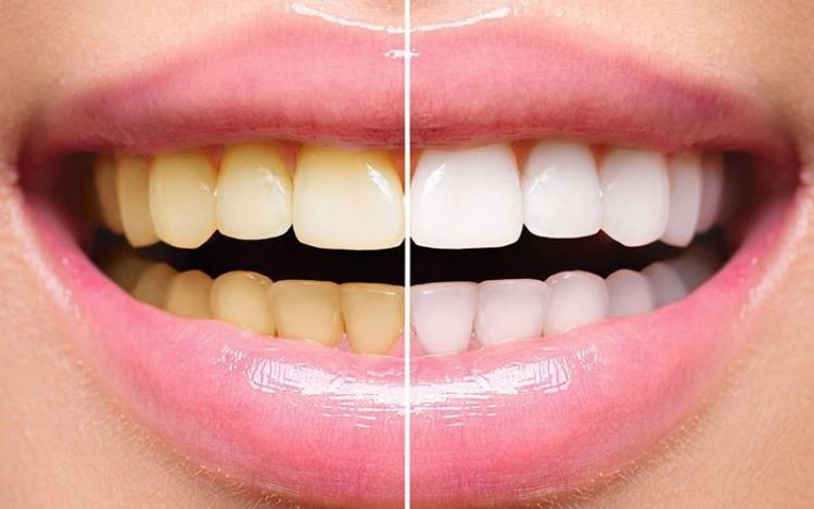 Punya Masalah Gigi Kuning? Ini 5 Cara Cepat Memutihkan Gigi Secara Alami